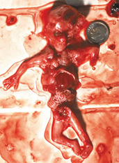 aborcja1